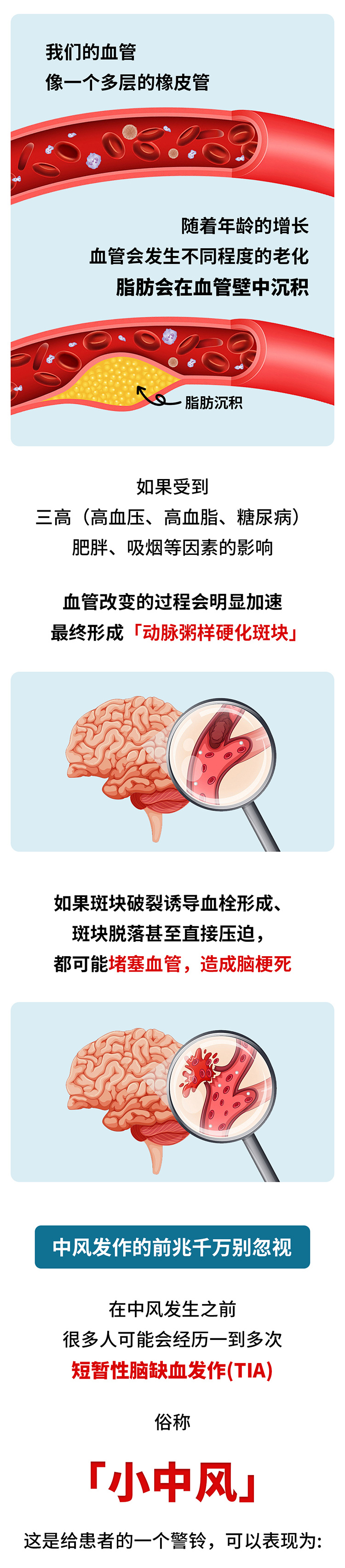 中風的5個前兆，盡早發現能救命_02.jpg